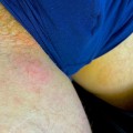 Understanding Swollen Lymph Nodes in the Groin Area