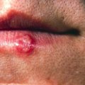Herpes Simplex Virus (HSV) Infection