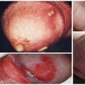 Understanding Gonorrhea Infection