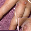 Understanding Sores, Bumps, Blisters, and Rashes on the Genitals and Anus