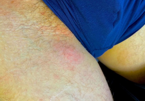 Understanding Swollen Lymph Nodes in the Groin Area