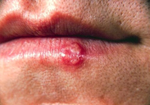 Herpes Simplex Virus (HSV) Infection