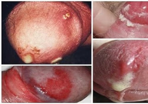 Understanding Gonorrhea Infection