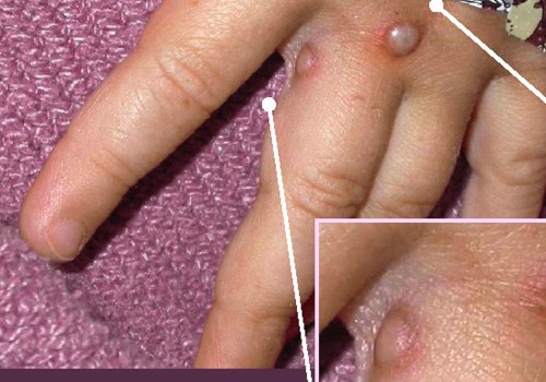 Understanding Sores, Bumps, Blisters, and Rashes on the Genitals and Anus